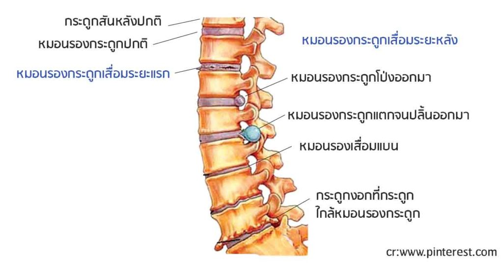 ปวดหลัง หายได้ด้วย กายภาพบำบัด