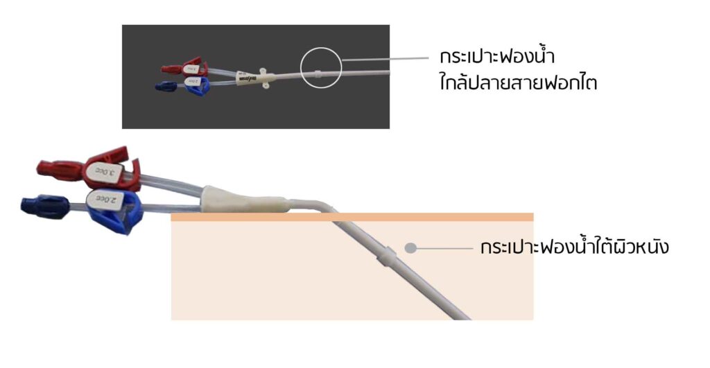 ผ่าตัดเส้นฟอกไต